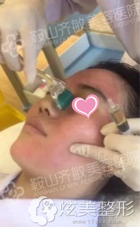 肖琳医生为我做微针美肤中 肖琳医生为我做微针美肤中