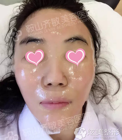 做完微针美肤后敷面膜 做完微针美肤后敷面膜