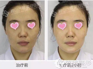 在鞍山齐敏整形做微针美肤前后对比 在鞍山齐敏整形做微针美肤前后对比