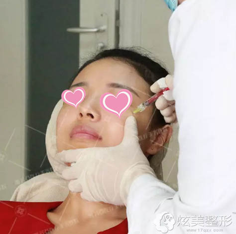 雅芳亚整形医生为我注射玻尿酸丰苹果肌 雅芳亚整形医生为我注射玻尿酸丰苹果肌