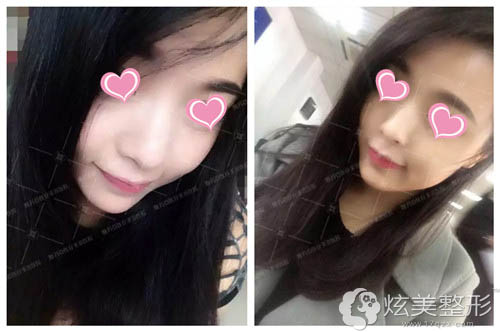 注射微整形3天后脸小且面部饱满 注射微整形3天后脸小且面部饱满
