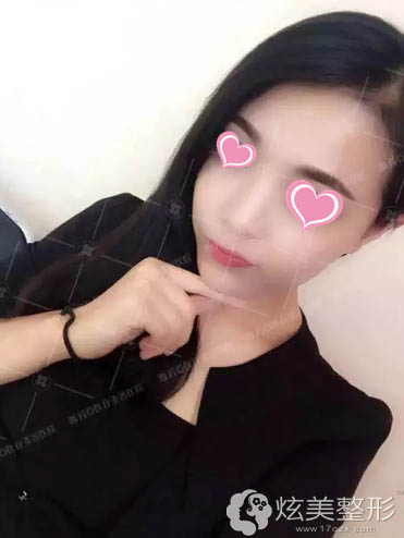 在雅芳亚做注射微整形7天后变化越来越大 在雅芳亚做注射微整形7天后变化越来越大