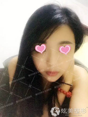 注射微整形15天后脸型超精致立体 注射微整形15天后脸型超精致立体