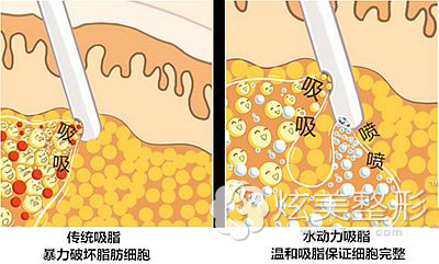 水动力吸脂和传统吸脂区别 水动力吸脂和传统吸脂区别