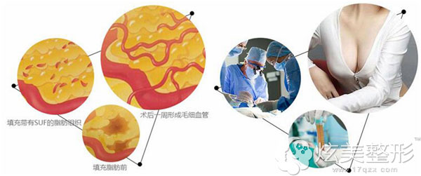 广元朗睿自体脂肪吸脂填充丰胸技术 广元朗睿自体脂肪吸脂填充丰胸技术