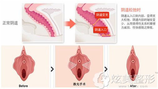 私密整形前后对比 私密整形前后对比