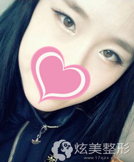˫��Ƥ����2�����Ѿ��ָ���Ȼ