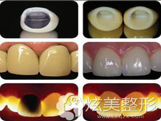 烤瓷牙和全瓷牙不同的透明程度 烤瓷牙和全瓷牙不同的透明程度