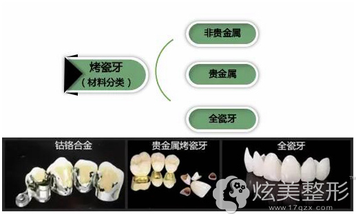 烤瓷牙的主要分类,全瓷牙是其中一种 烤瓷牙的主要分类,全瓷牙是其中一种