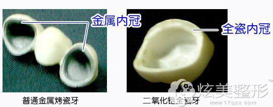 烤瓷牙是金属内冠,全瓷牙是全瓷内冠 烤瓷牙是金属内冠,全瓷牙是全瓷内冠