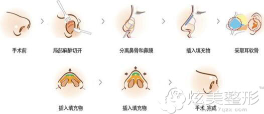 自体耳软骨垫鼻尖示意图 自体耳软骨垫鼻尖示意图