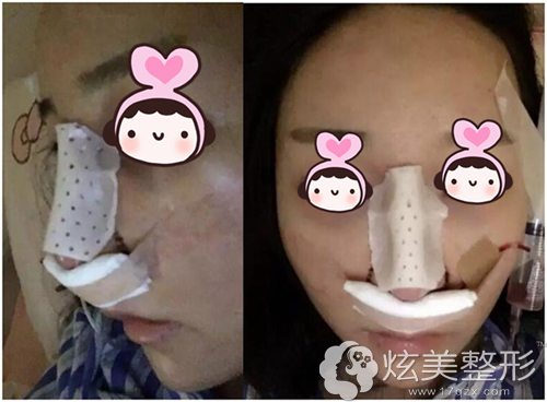 射极峰膨体隆鼻术后即刻效果 射极峰膨体隆鼻术后即刻效果
