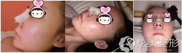 隆鼻术后三天还处于肿胀过程中 隆鼻术后三天还处于肿胀过程中