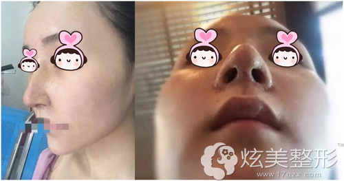 无锡爱思特隆鼻术后七天拆线 无锡爱思特隆鼻术后七天拆线