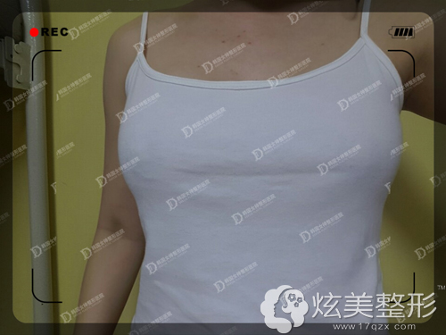 韩国女神案例证明:比圆形隆胸假体更贵的水滴形效果更好