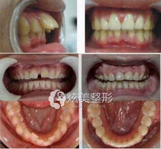 广州拜博牙齿矫正案例 广州拜博牙齿矫正案例