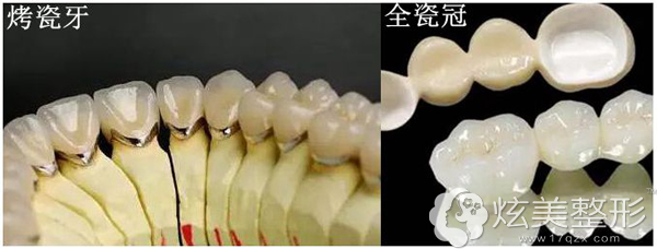 烤瓷牙和全瓷冠对于牙齿美白 烤瓷牙和全瓷冠对于牙齿美白