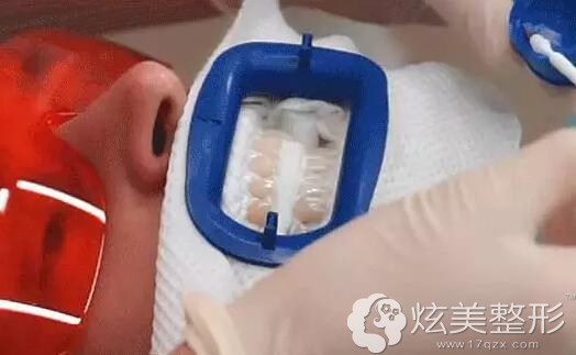 冷光美白牙齿方法 冷光美白牙齿方法