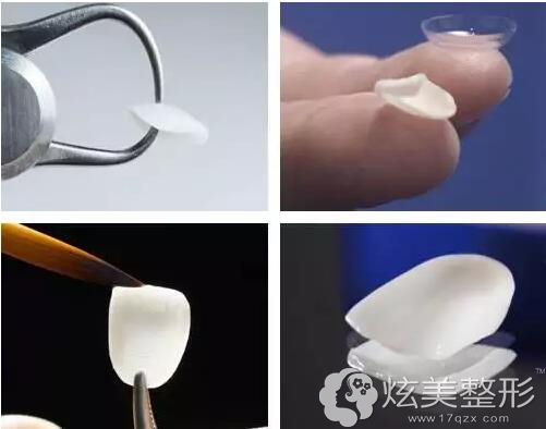 牙贴面改善牙齿美白 牙贴面改善牙齿美白