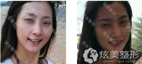 隆鼻和改脸型术前样子 隆鼻和改脸型术前样子