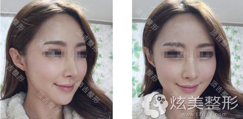 武汉顶吉做隆鼻加改脸型术后效果 武汉顶吉做隆鼻加改脸型术后效果