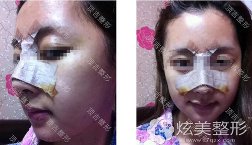 下颌角整形加隆鼻术后第三天 下颌角整形加隆鼻术后第三天