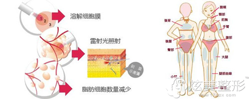 激光溶脂减肥不会反弹 激光溶脂减肥不会反弹