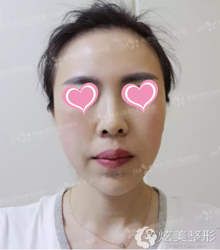 在集美做完1次皮秒肌肤嫩白 在集美做完1次皮秒肌肤嫩白