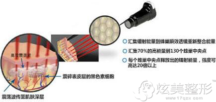 集美整形皮秒祛除色斑效果显著 集美整形皮秒祛除色斑效果显著