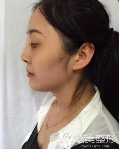 微晶瓷隆鼻后,虽然鼻梁确实比以前高了,但是鼻子高得一点也不自然