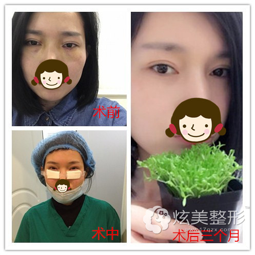 承德玥莱美去眼袋术前术后对比
