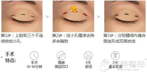 芘丽芙整形定制双眼皮术 芘丽芙定制双眼皮术