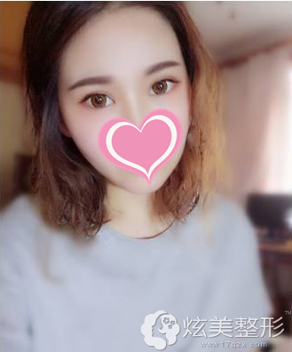 术后25天恢复自然有神的眼睛 术后25天恢复自然有神的眼睛