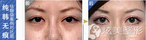 祛眼袋真人案例效果对比图南通维多利亚 祛眼袋真人案例效果对比图南通维多利亚