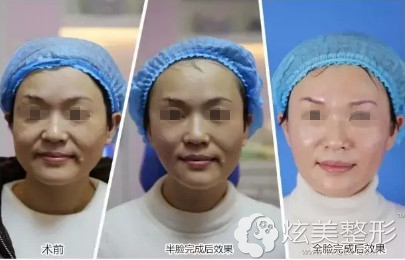 线雕提升的恢复过程 线雕提升的恢复过程