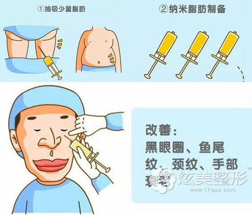 纳米脂肪填充去黑眼圈 纳米脂肪填充去黑眼圈