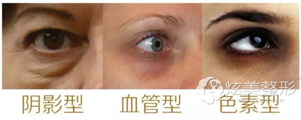 三种黑眼圈的不同类型 三种黑眼圈的不同类型