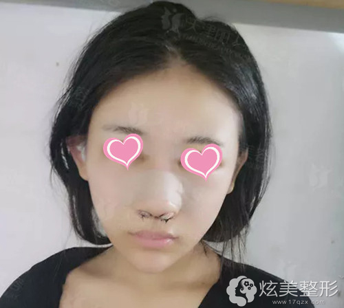 刚做完鼻综合手术处于肿胀期 刚做完鼻综合手术处于肿胀期