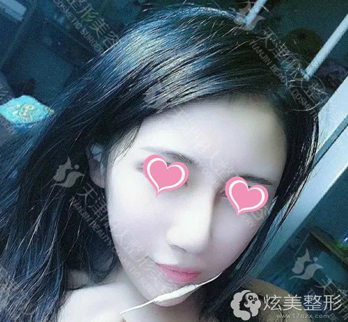 做完手术15天鼻子恢复中 做完手术15天鼻子恢复中