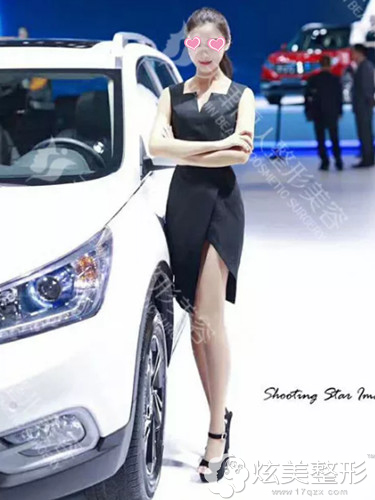术后30天鼻子恢复自然 术后30天鼻子恢复自然