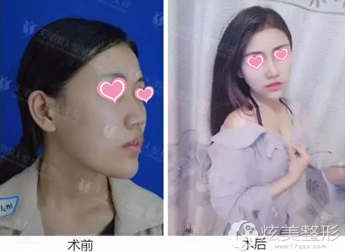 鼻综合整形前后对比 鼻综合整形前后对比