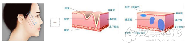 线雕提升加上玻尿酸联合除皱 线雕提升加上玻尿酸联合除皱
