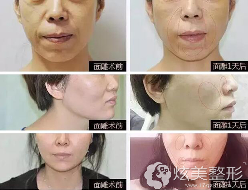 在呼和浩特京美做线雕提升案例 在呼和浩特京美做线雕提升案例
