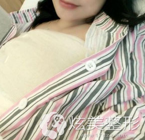 绍兴上虞艺美整形假体隆胸术后即刻 绍兴上虞艺美整形假体隆胸术后即刻