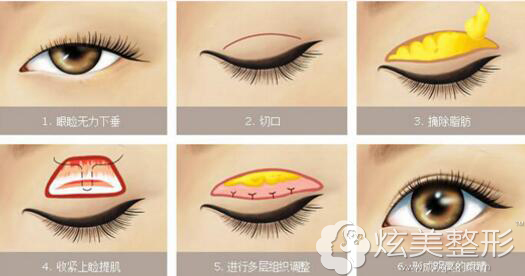 上海华美芭比眼上眼提肌过程 上海华美芭比眼上眼提肌过程