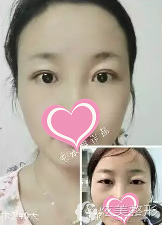 看案例见证效果整形案例 - 中韩甘肃兰州jk整形美容中心 - - 炫美网