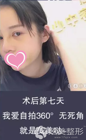 术后7天拆线后双眼皮和鼻子的样子 术后7天拆线后双眼皮和鼻子的样子