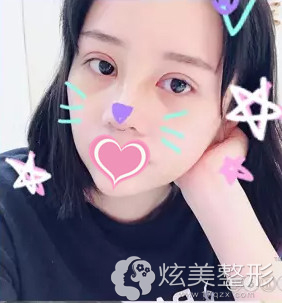 手术10天后双眼皮和鼻子有些肿胀 手术10天后双眼皮和鼻子有些肿胀