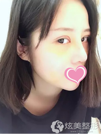 术后15天双眼皮和鼻子慢慢恢复中 术后15天双眼皮和鼻子慢慢恢复中