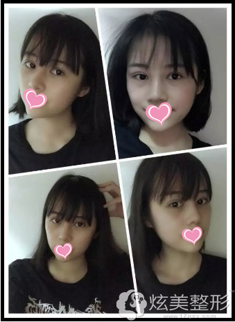20天后双眼皮和鼻子恢复自然 20天后双眼皮和鼻子恢复自然